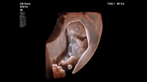 3D9-3v 3D TrueVue Fetal Imaging