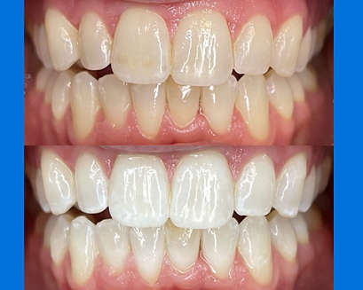 Pictures of teeth before and after Philips Zoom! shade difference