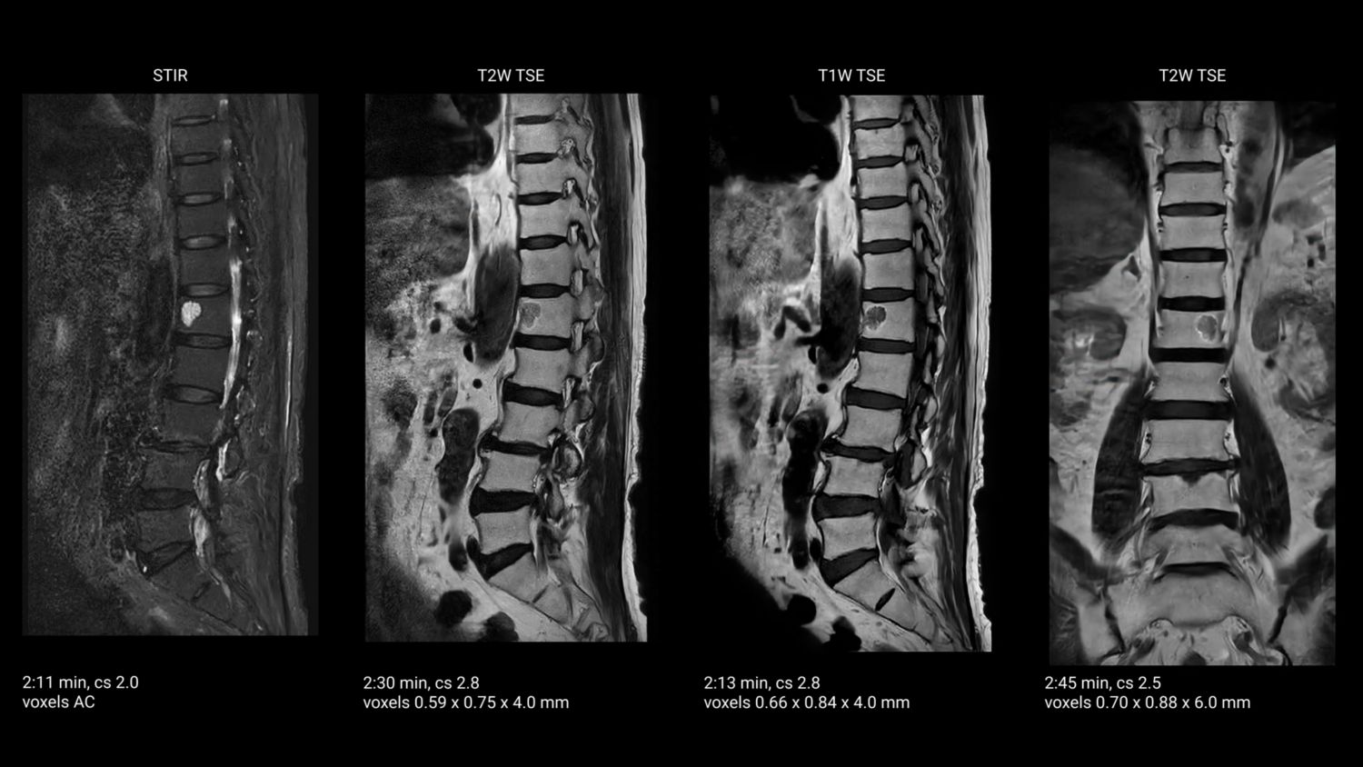 Lumbar spine MRI showing a cyst
