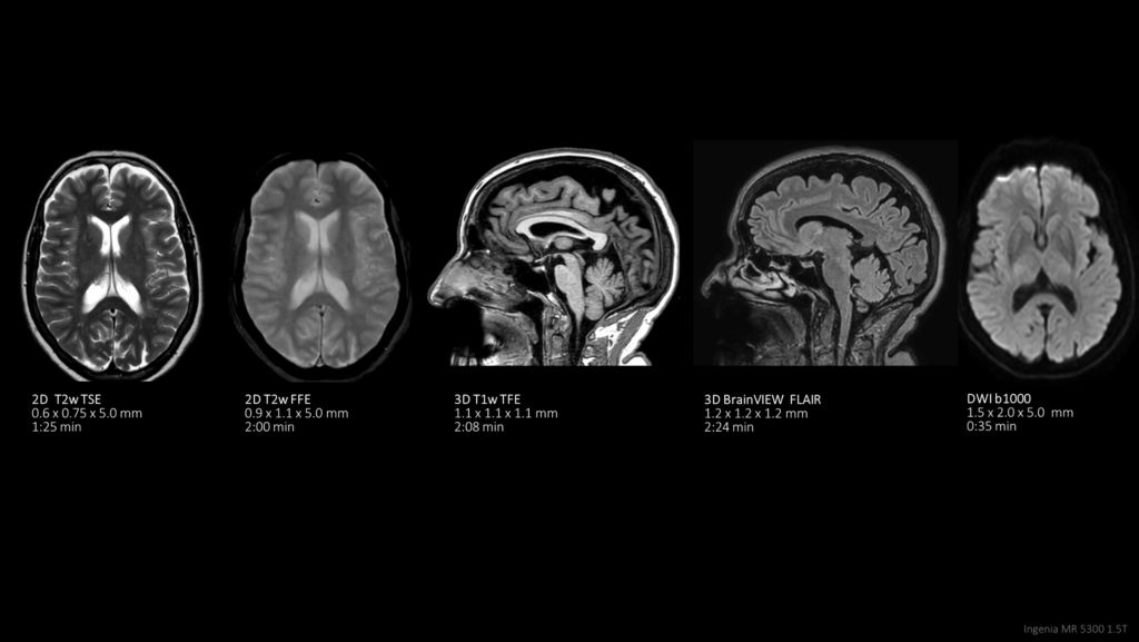 Brain on Ambition 1.5T with SmartSpeed