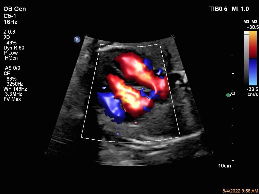 Fetal heart four-chamber color flow with Flow Viewer