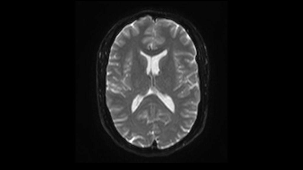 DWI b0 clinical image of the brain