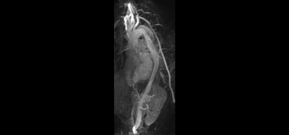 4D-TRAK XD (showing false lumen in aorta)