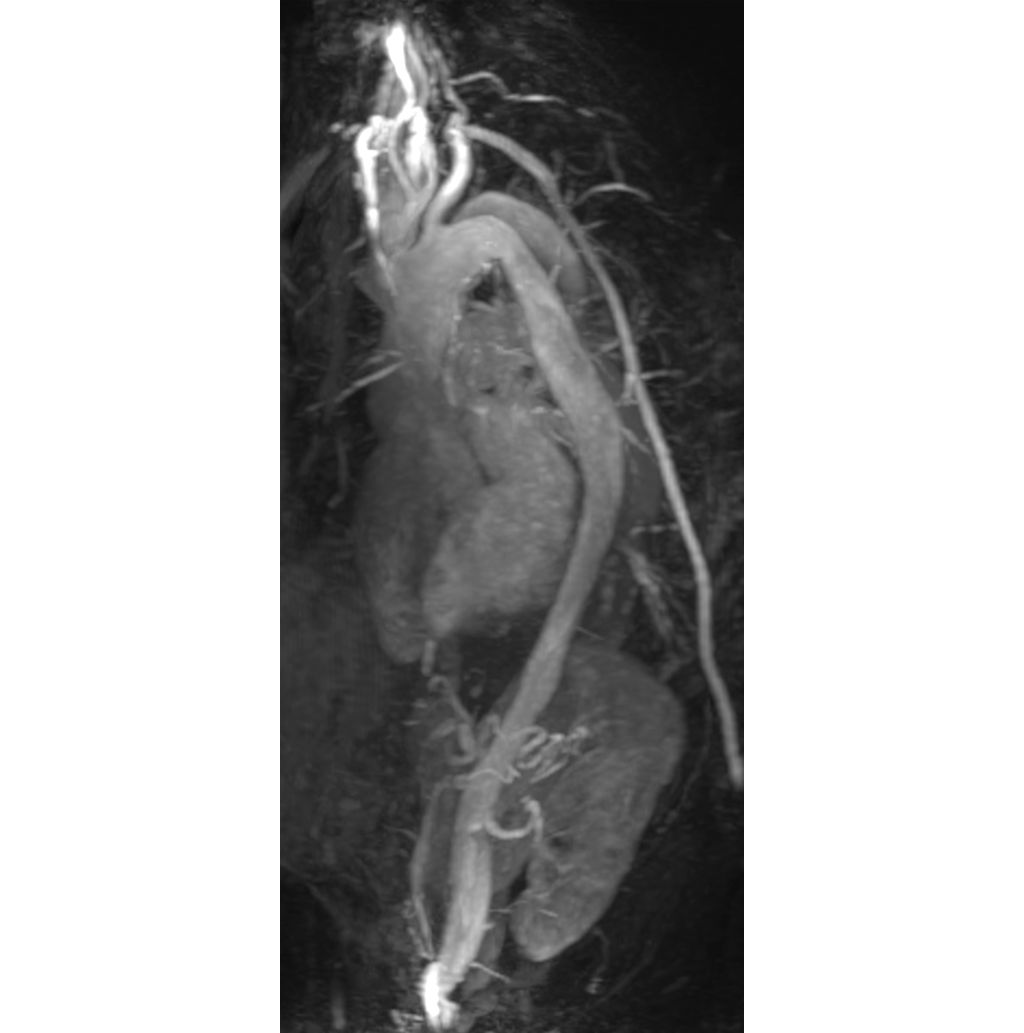 4D-TRAK XD (showing false lumen in aorta)