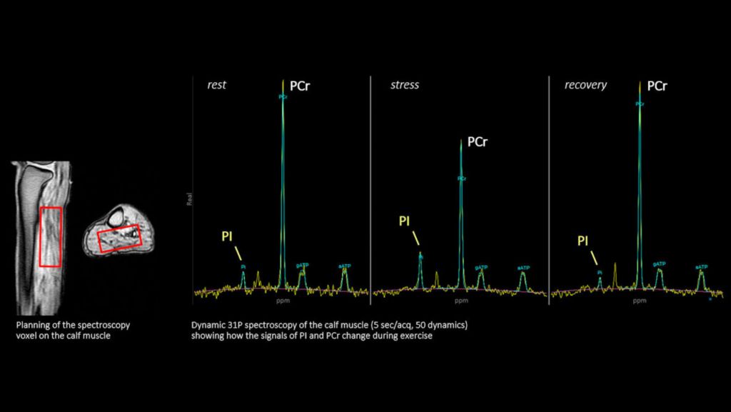 P140 Calf muscle (3 dynamics)
