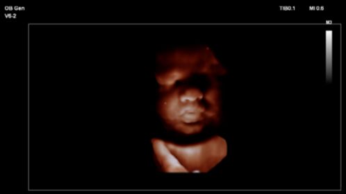 Fetal image shown with TrueVue on V6-2 transducer