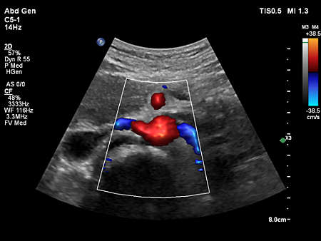 C5-1 Renal Artery Origin with FlowViewer