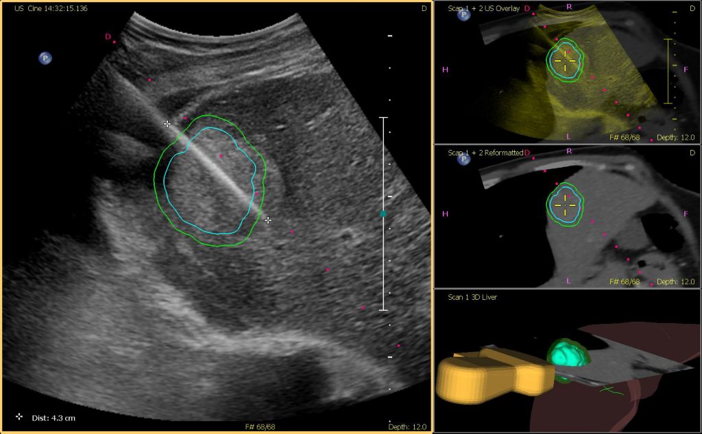 Fusion-guided Ablation with Tumor Contour
