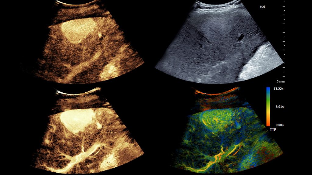 Abdominal clinical image showing CEUS FNH SBS using C5-1 transducer