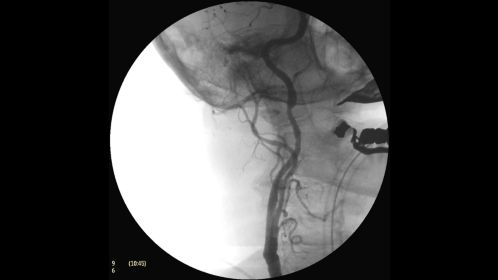 Clinical Image Philips BV Mobile C-arm Pulsera