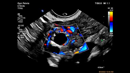 C10-3v Ovary Perfusion wit Flow Viewer