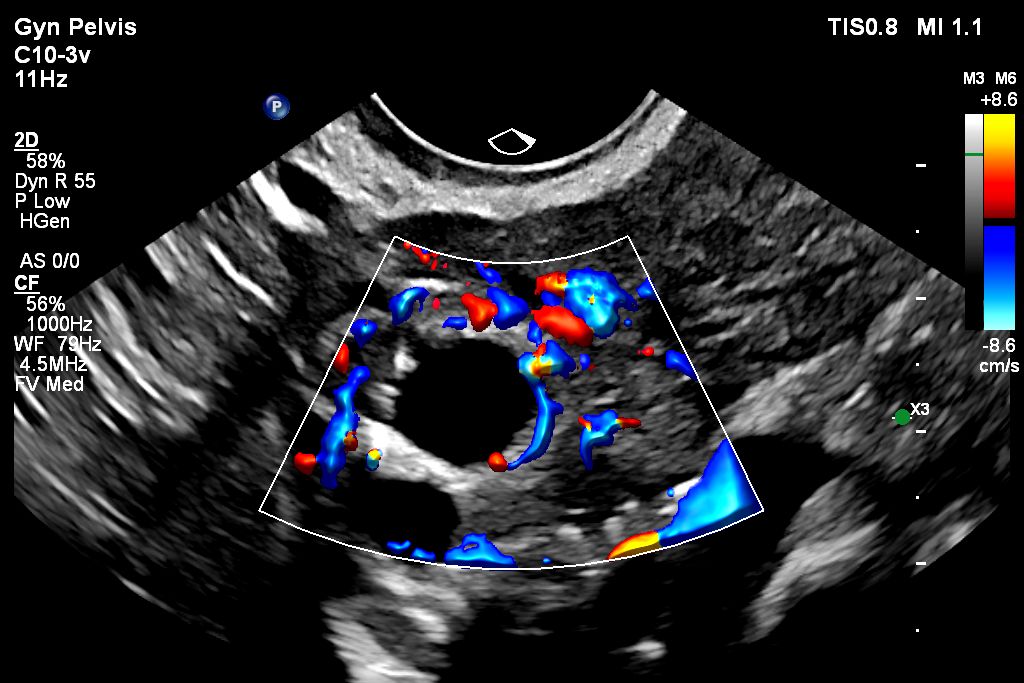 Color Flow with Flow Viewer using C10-3v showing ovary perfusion