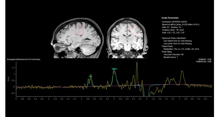 MEGA MR Clinical application | Philips