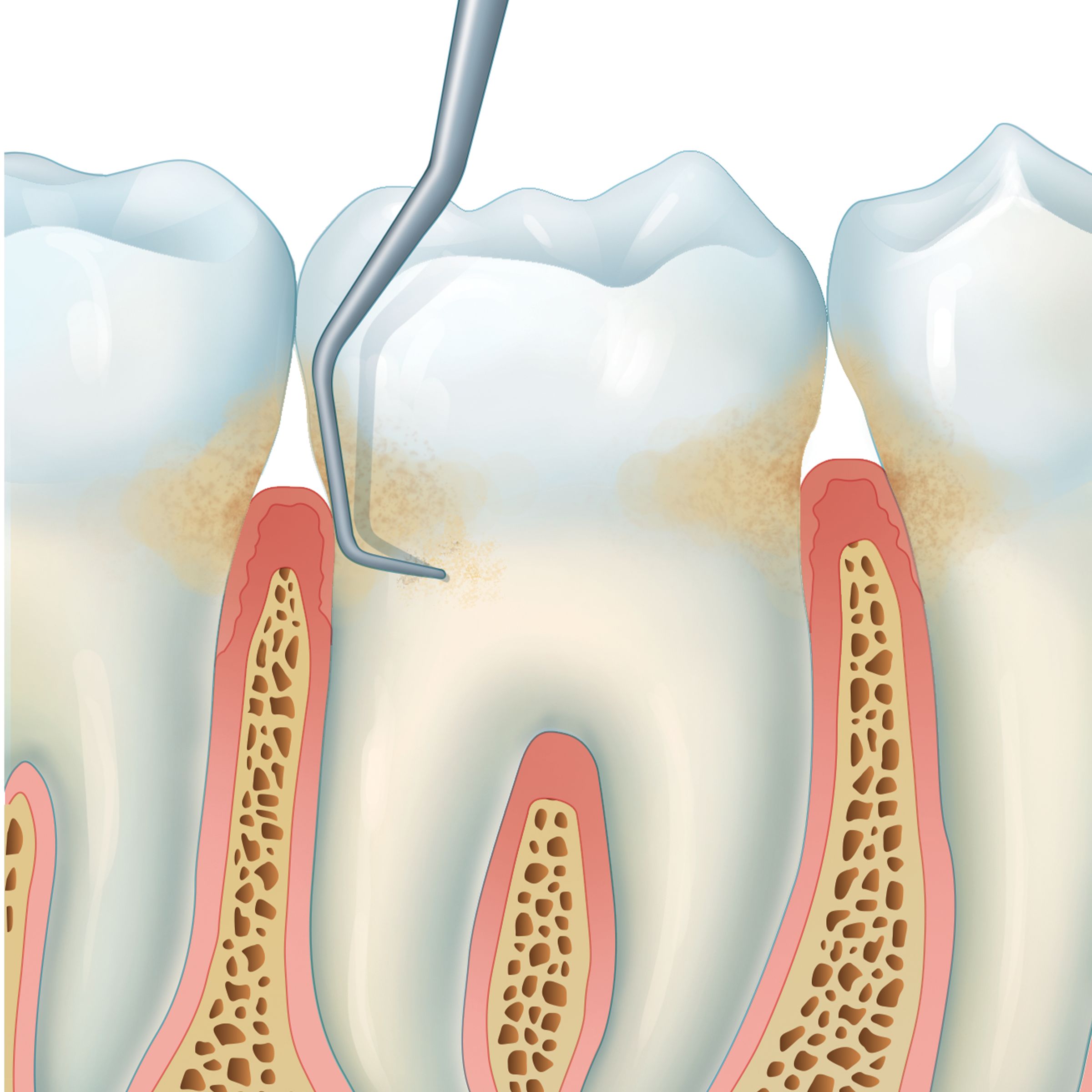 Periodontitis clinical image