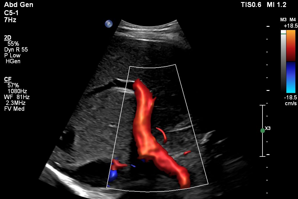 EPIQ scan of the liver, without Next Gen AutoSCAN