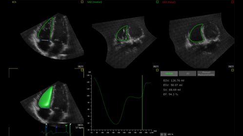 Ultrasound Workspace 3D Auto RV