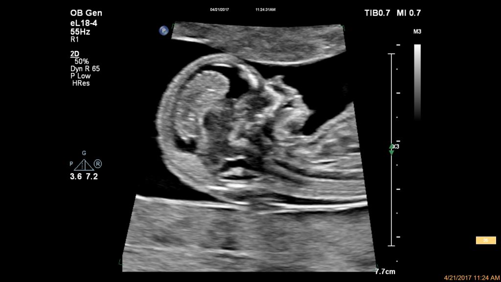 Fetal profile-eL18-4