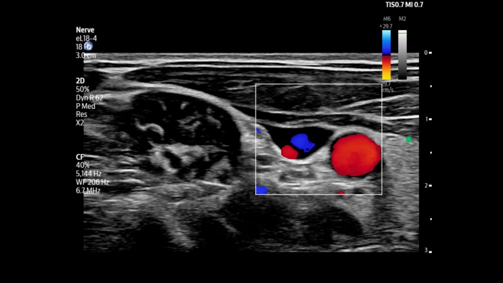Carotid artery and internal jugular vein with color flow Doppler shown using eL18-4 transducer.