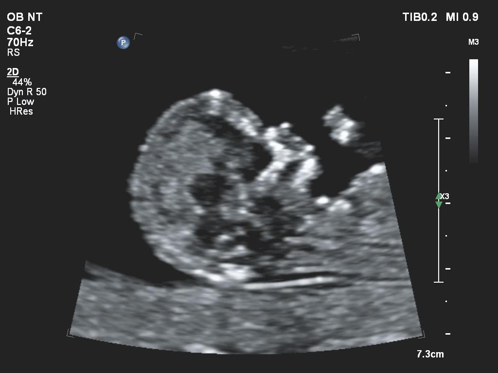 Affiniti 30 ultrasound clinical image obstetric NT