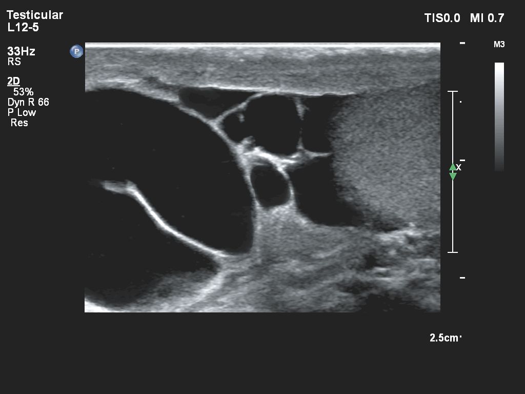 Affiniti 30 ultrasound clinical image small parts testicular