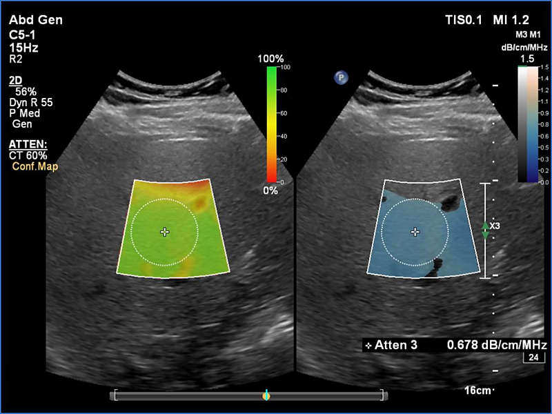 Liver Fat Quantification (LFQ) clinical image