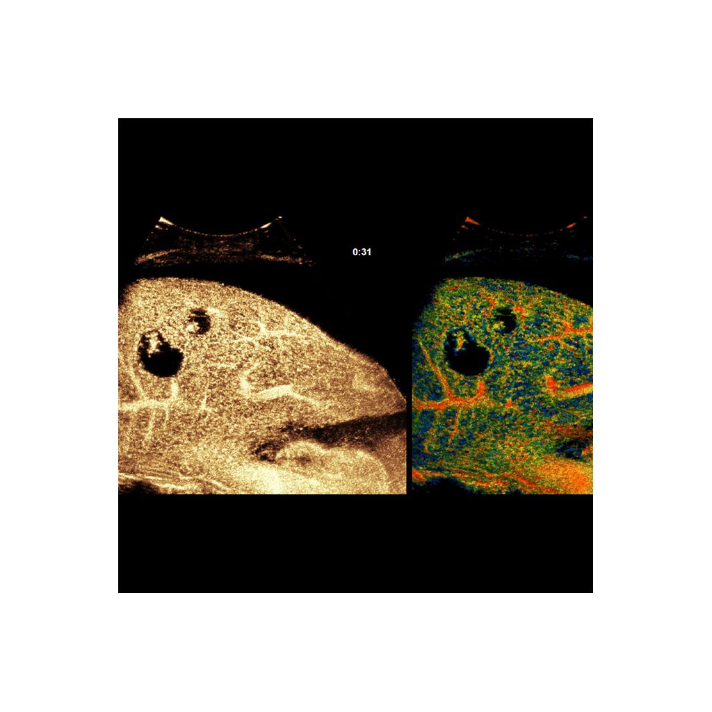 Super Res MVI Pro* clinical image showing TOA map of cystic liver lesions