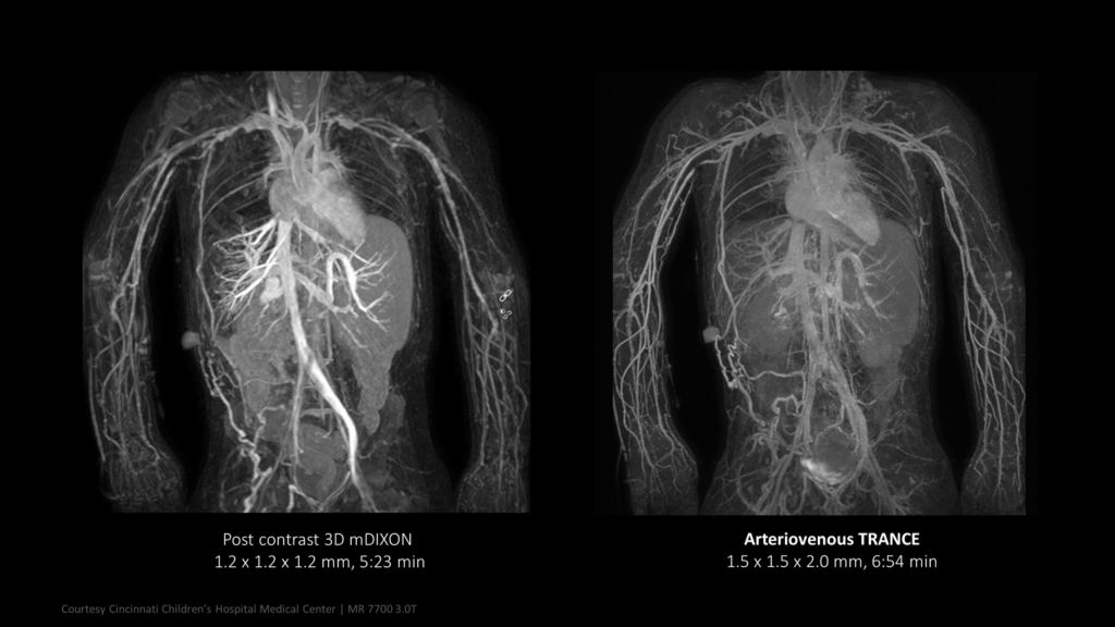 Non-contrast angiography with Arteriovenous TRANCE