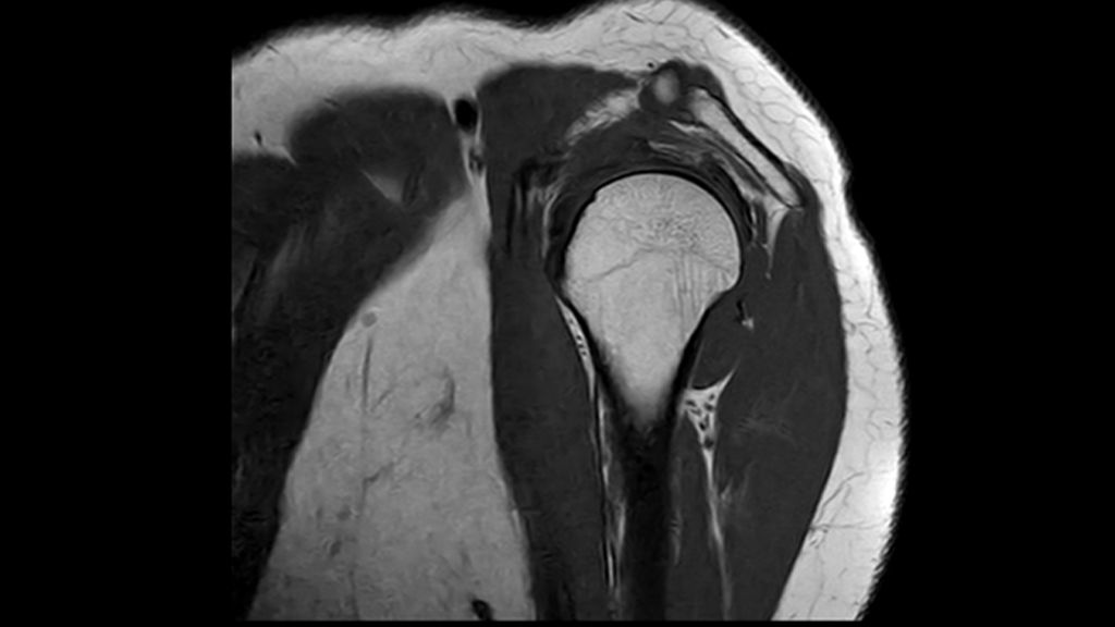 SmartFit Shoulder coil