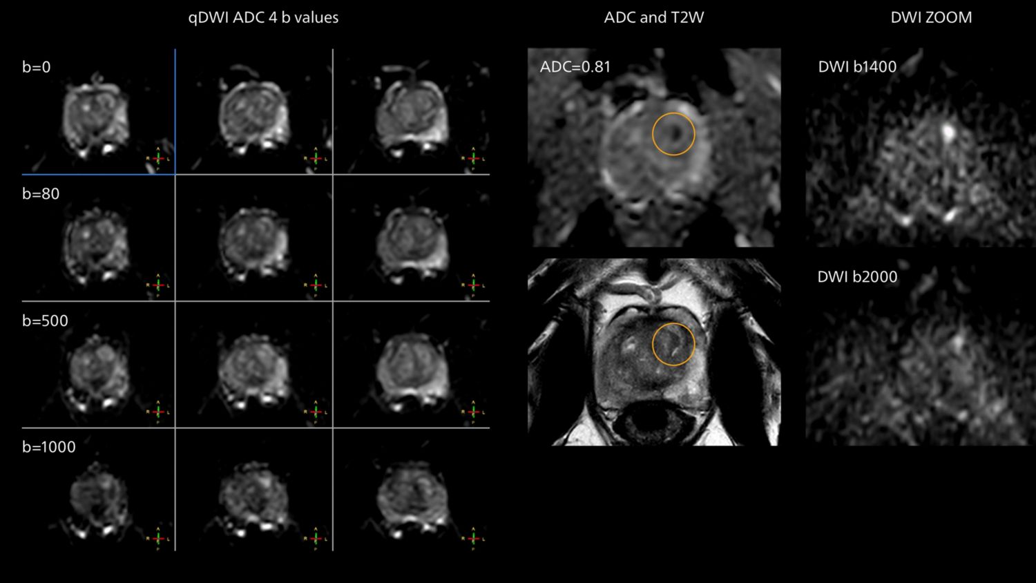Diffusion weighted MR imaging of prostate