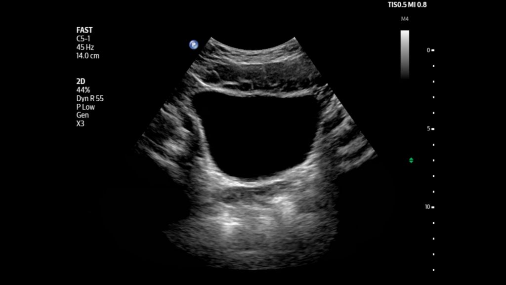FAST bladder image shown using C5-1 transducer.