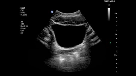 FAST bladder image shown using C5-1 transducer.