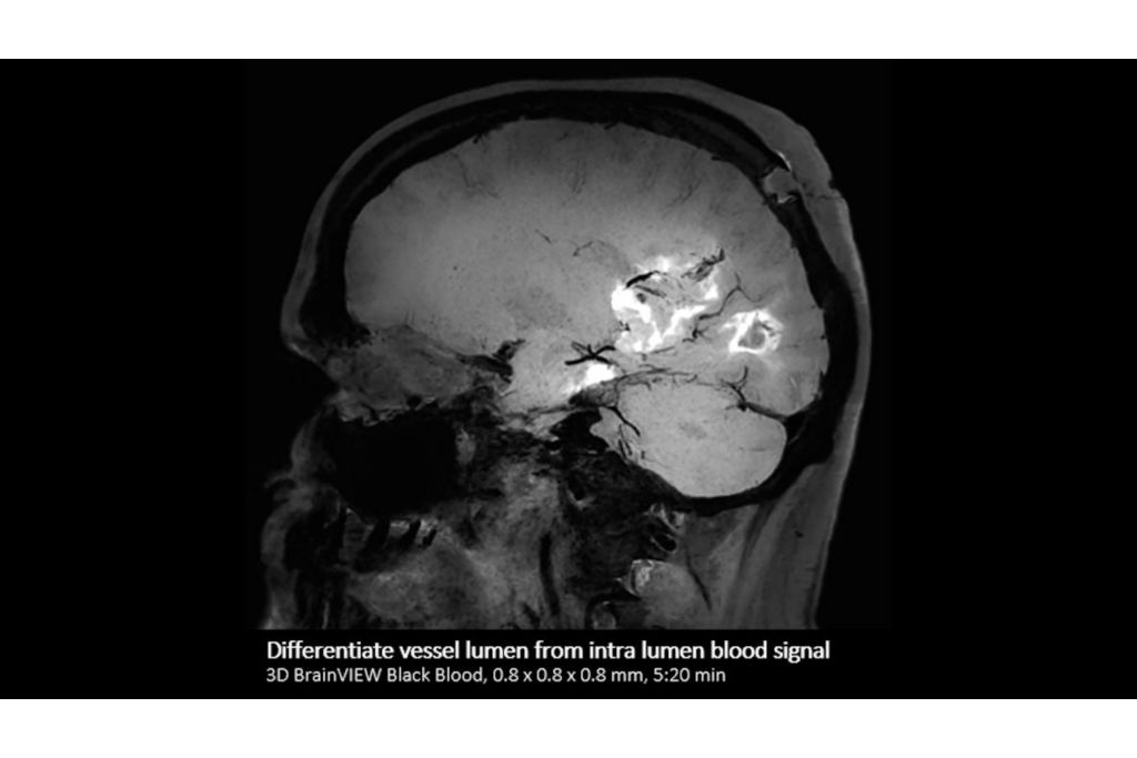 Brain Black Blood imaging