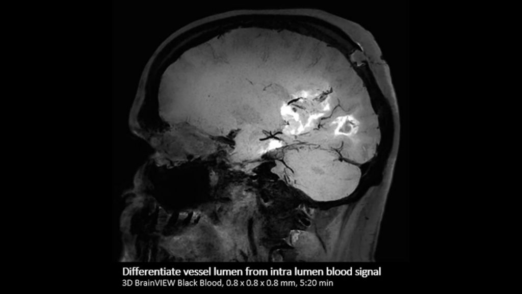 Brain Black Blood imaging
