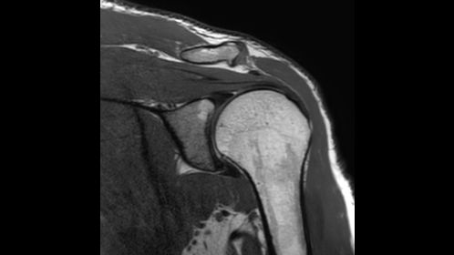 Coronal 3D PDw TSE