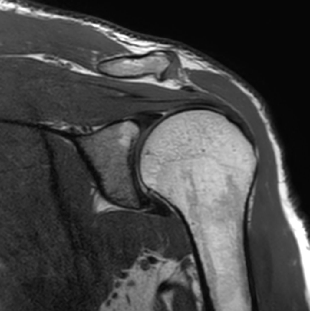 Coronal 3D PDw TSE