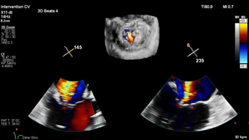 Live 3D TEE CV Ultrasound Imaging
