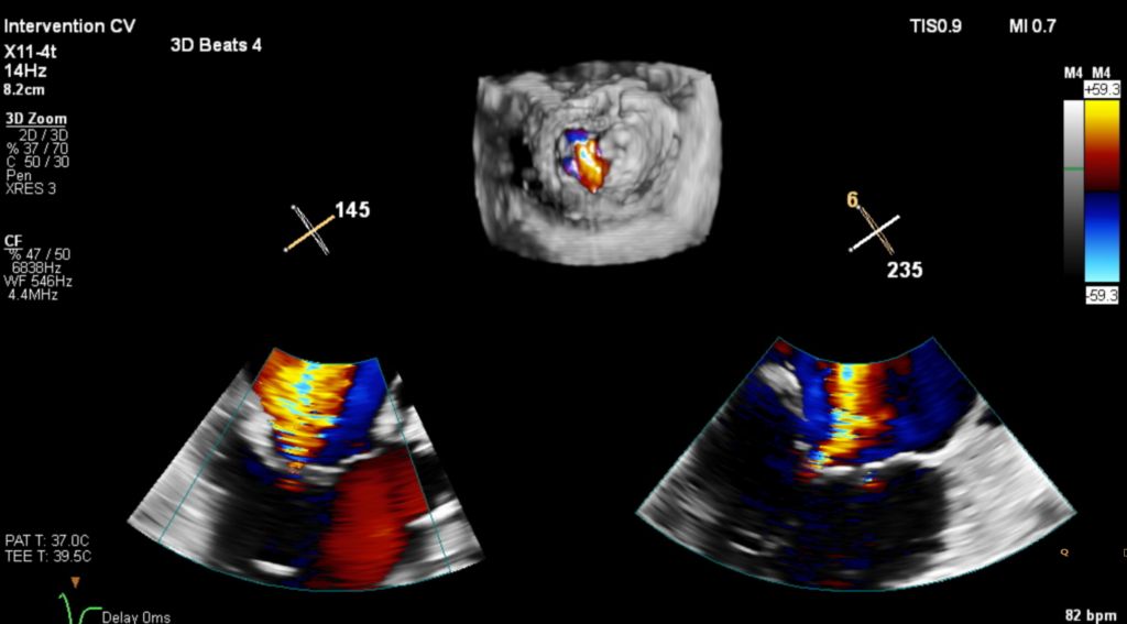 Live 3D TEE CV Ultrasound Imaging