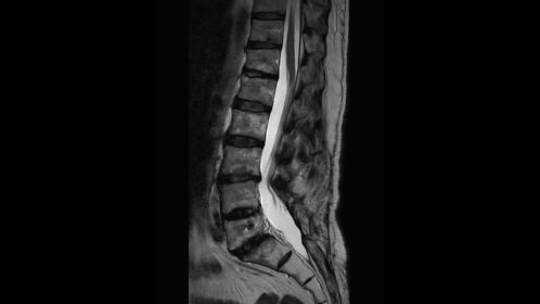 Sagittal T2w TSE (post surgical)