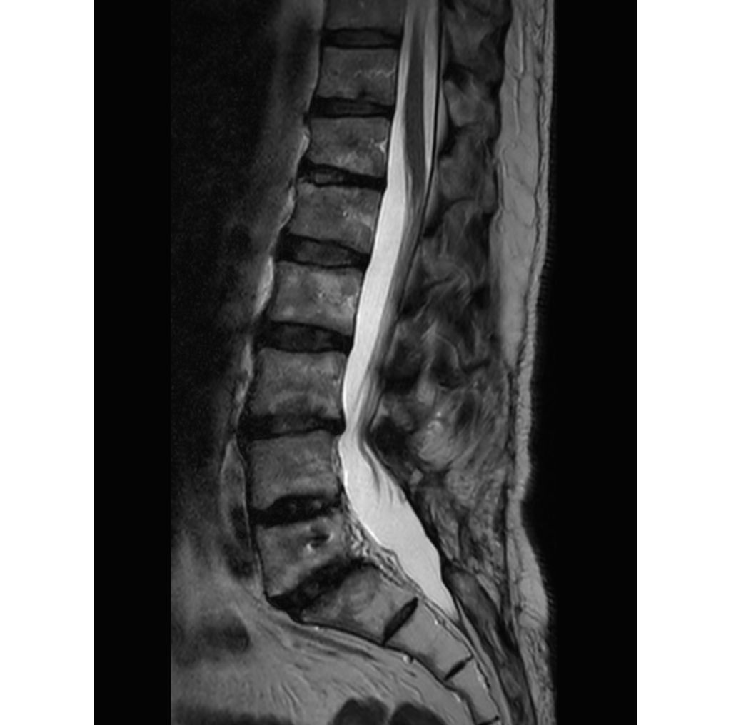 Sagittal T2w TSE (post surgical)