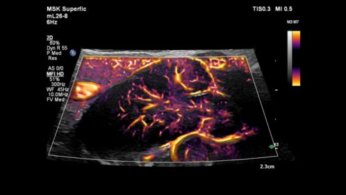 mL26-8 Paired with MFI on a Pediatric Lymph Node