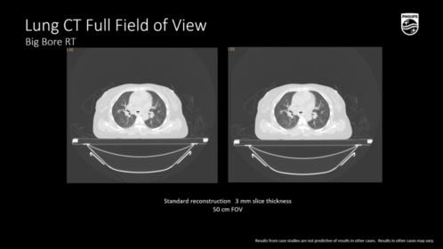 BBRT lung CT Full FOV 3mm slice thickness
