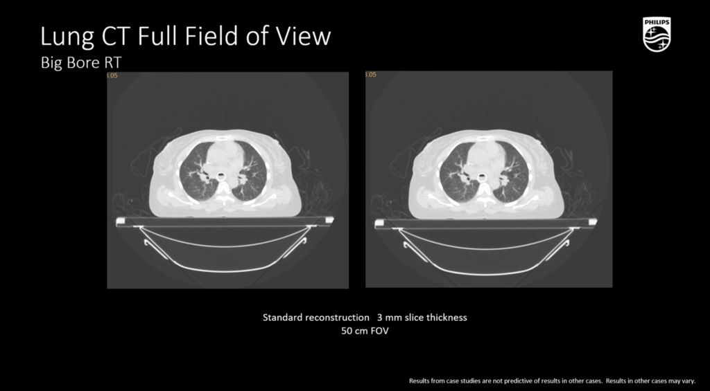 BBRT lung CT Full FOV 3mm slice thickness