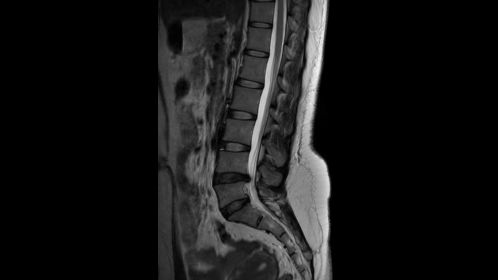 Sagittal T2w TSE 