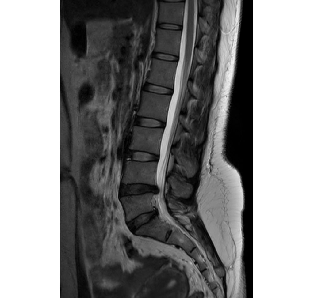 Sagittal T2w TSE 