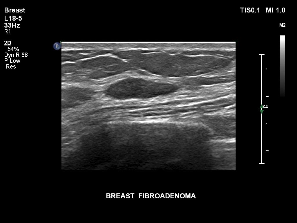 Breast fibroadenoma
