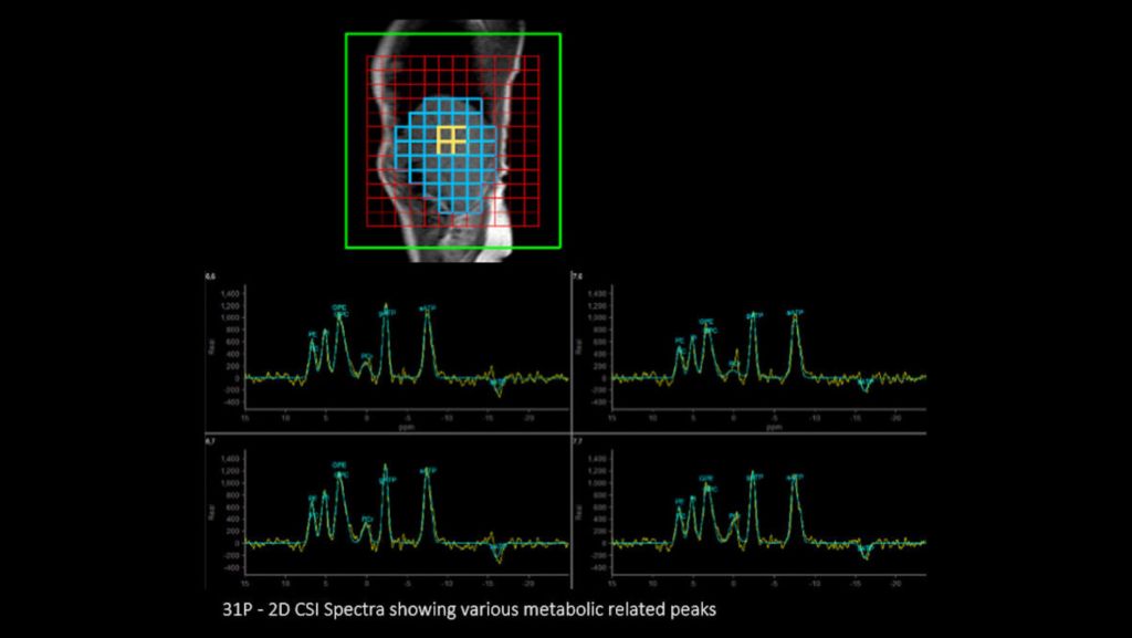 P140 Liver 2D CSI