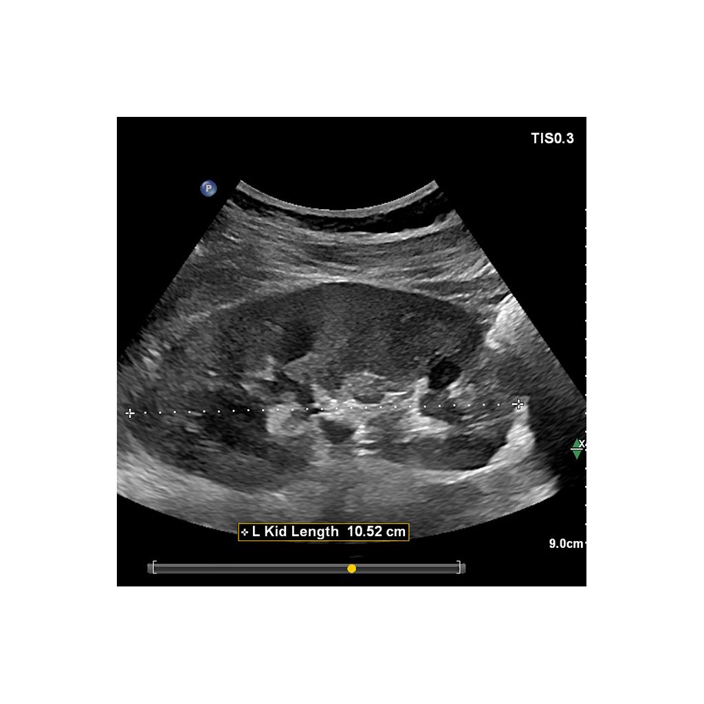 Clinical image using EPIQ Elite and C5-1 transducer to show left kidney length 
