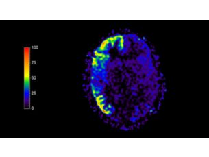 3D ASL Zastosowania kliniczne obrazowania MR