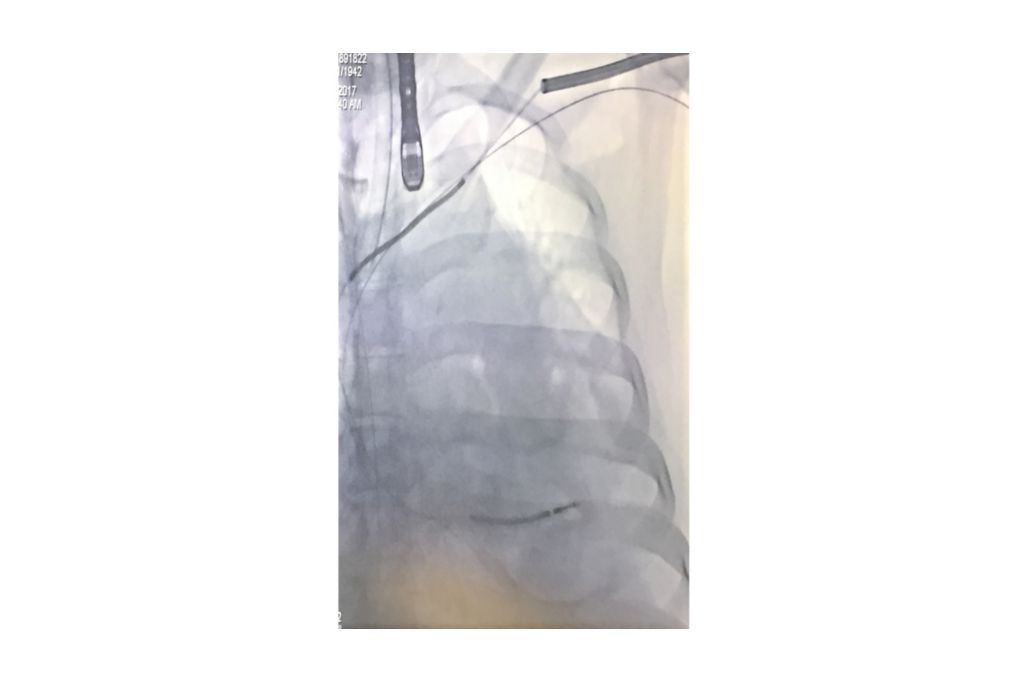 TightRail Sub-C mechanical
rotating dilator sheath