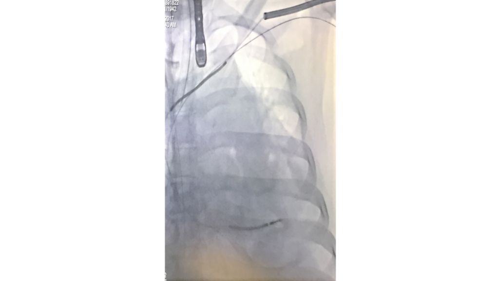 TightRail Sub-C mechanical
rotating dilator sheath